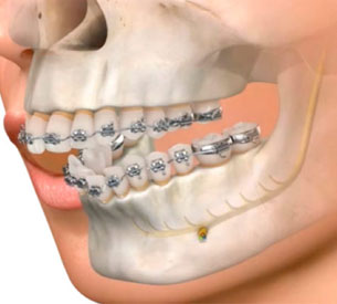 Cirurgia Bucomaxilofacial